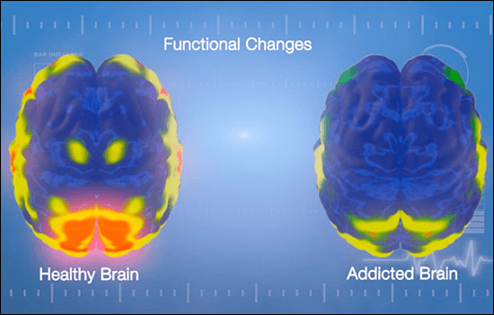 The addicted brain shows different brain activity than a healthy one